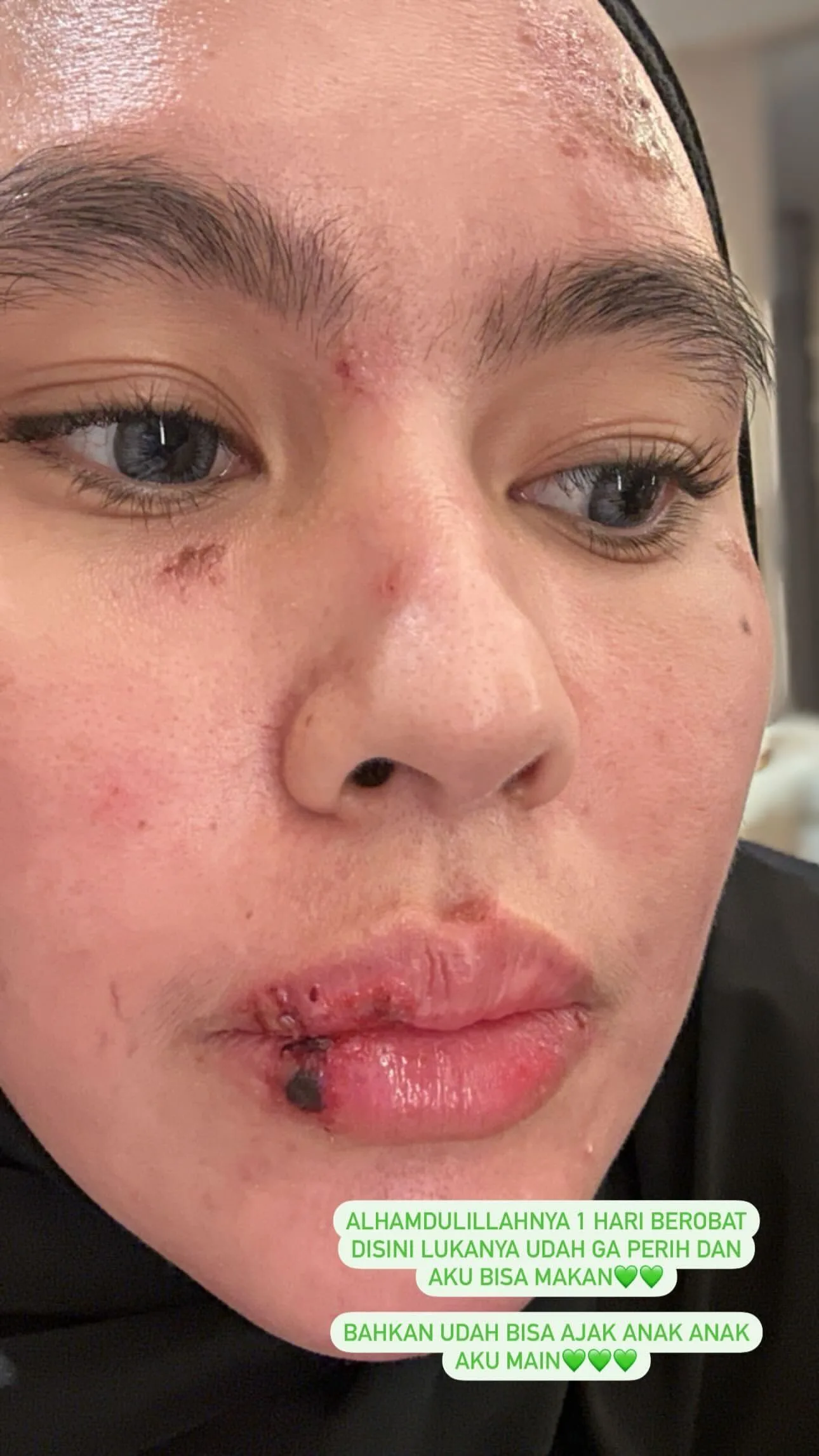 Menderita Penyakit Misterius, Kartika Putri Berobat ke Singapura