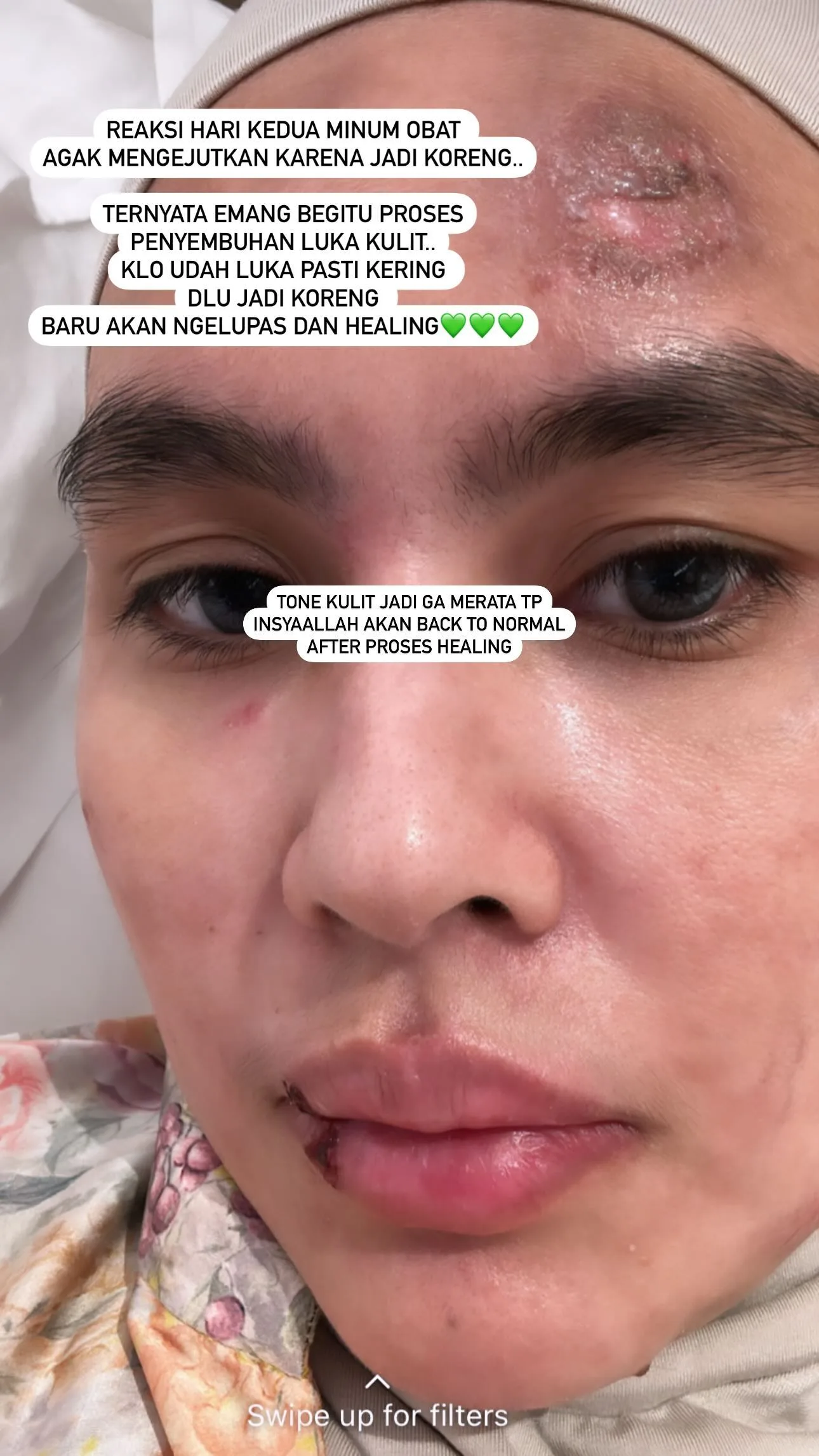 Menderita Penyakit Misterius, Kartika Putri Berobat ke Singapura