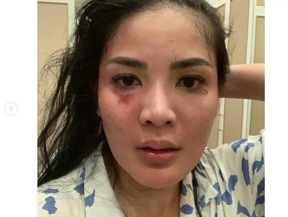 Alami KDRT Sejak Awal Menikah Nindy Ayunda Gugat Cerai Suami